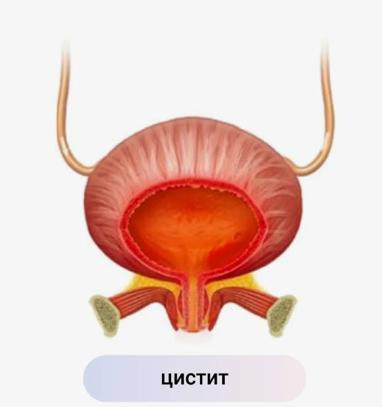 Цистит